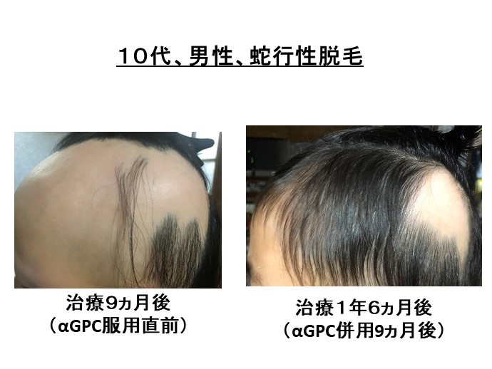 円形脱毛症　病院
